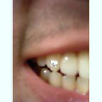 Diamond on a Tooth